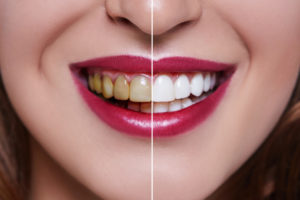 before and after teeth whitening close-up
